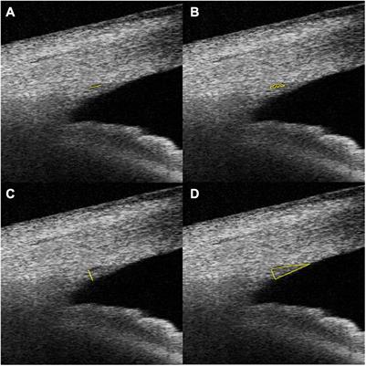 The Relationship Between Age and the Morphology of the Crystalline Lens, Ciliary Muscle, Trabecular Meshwork, and Schlemm’s Canal: An in vivo Swept-Source Optical Coherence Tomography Study